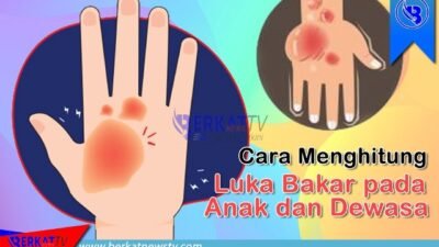 Cara menghitung luka bakar pada anak dan dewasa