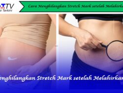 Cara Menghilangkan Stretch Mark setelah Melahirkan