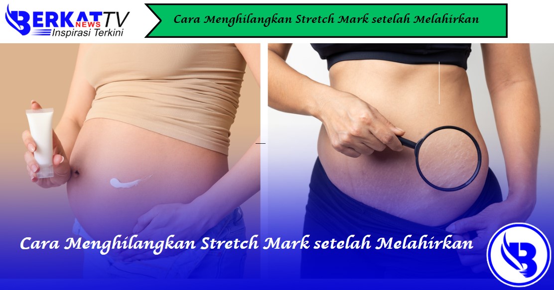 Cara Menghilangkan Stretch Mark setelah Melahirkan